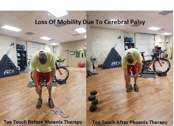 remote CRPS cerbral Palsy patient getting mobility work done with the direct current phoenix waveform resulting in increased range of motion