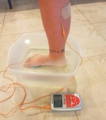 remote CRPS patient doing neurotherapy water bucket treatment with the Phoenix waveform direct current for relief from crps and neuropathy