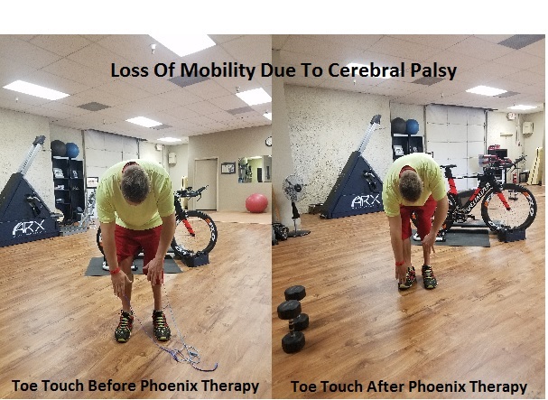 Functional Electrical Stimulation Complex regional pain syndrome (CRPS) ARPwave Phoenix Waveform